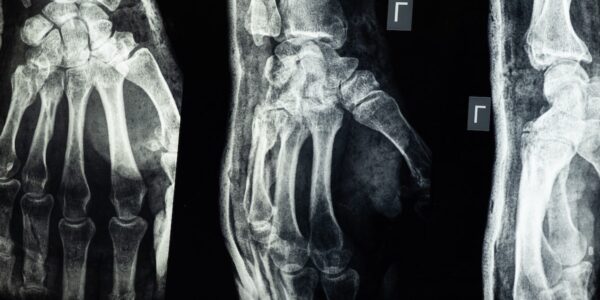 Fractured bones condition photo